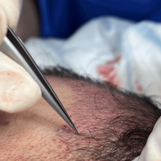 implant-capillaire-dr-grosdidier-challes